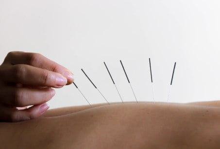 Acupuncture Toronto