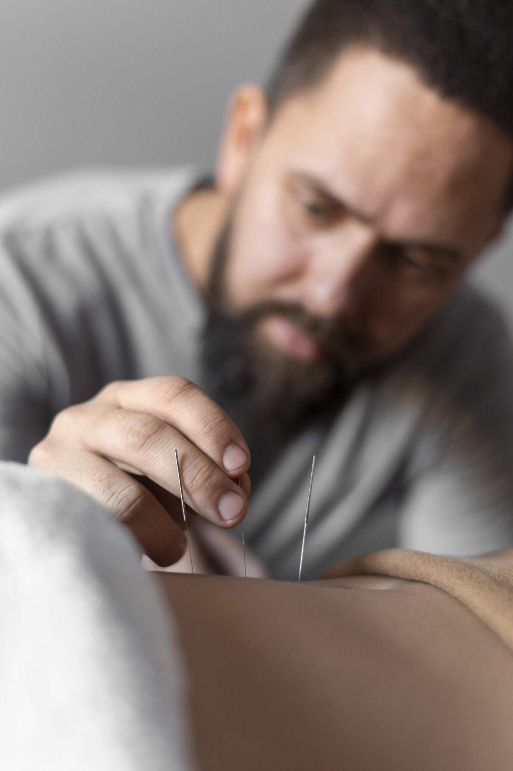 Acupuncture Services